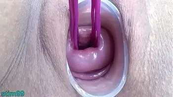 Prolapsed Cervix Lesbians at the same time